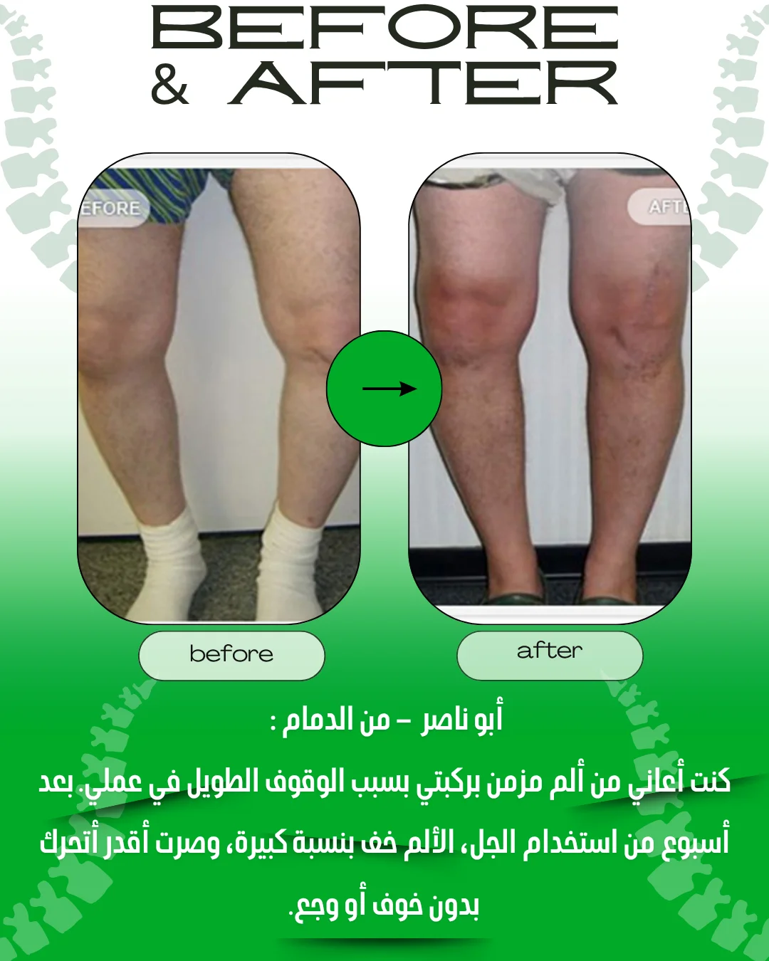 جل الفقرات القطنية المبرد